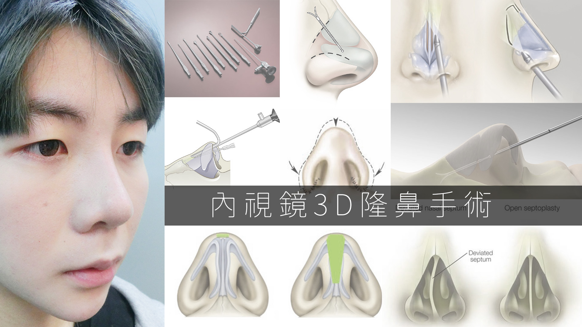 矯正 小鼻