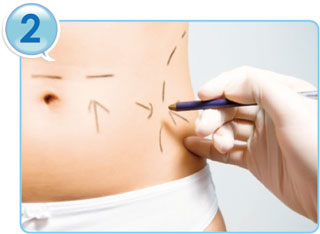 彭玉文醫師自體脂肪隆乳豐胸手術過程2